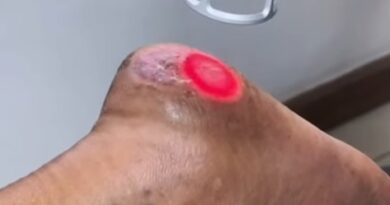 8 de cada 10 pacientes son diagnosticados con enfermedad venosa en Venezuela