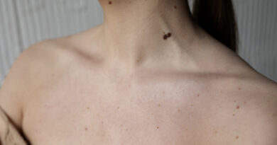 Tener más de 50 lunares puede ser un riesgo de Melanoma