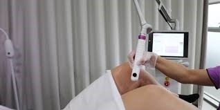 Revolución Láser en Ginecología: Más allá de la tecnología, una nueva era para la salud íntima femenina