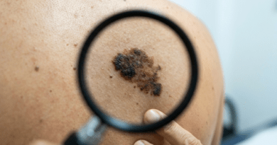 El Dr. Juan Carlos Narváez exige mayor prevención con el melanoma